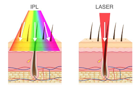 IPL и лазер для удаления волос: в чем разница?